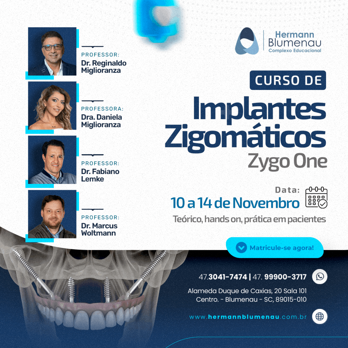 Implantes Zigomáticos